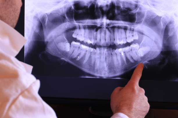 Best Knocked-Out Tooth (Avulsed Tooth) Treatment in Grandy, NC
